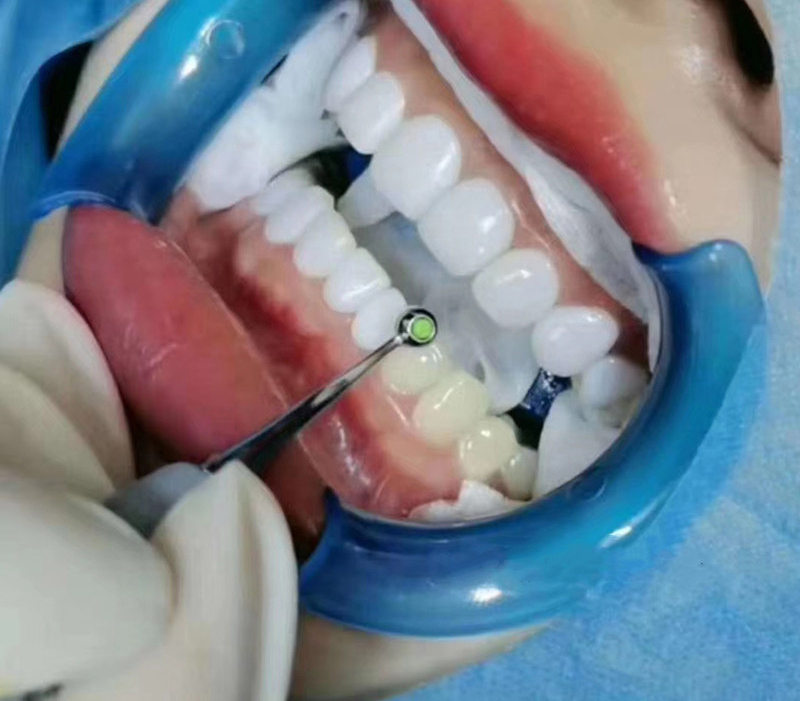 Dental Resin Filling Spatula D - Teeth Whitening Foam Toothpaste 评论和价格